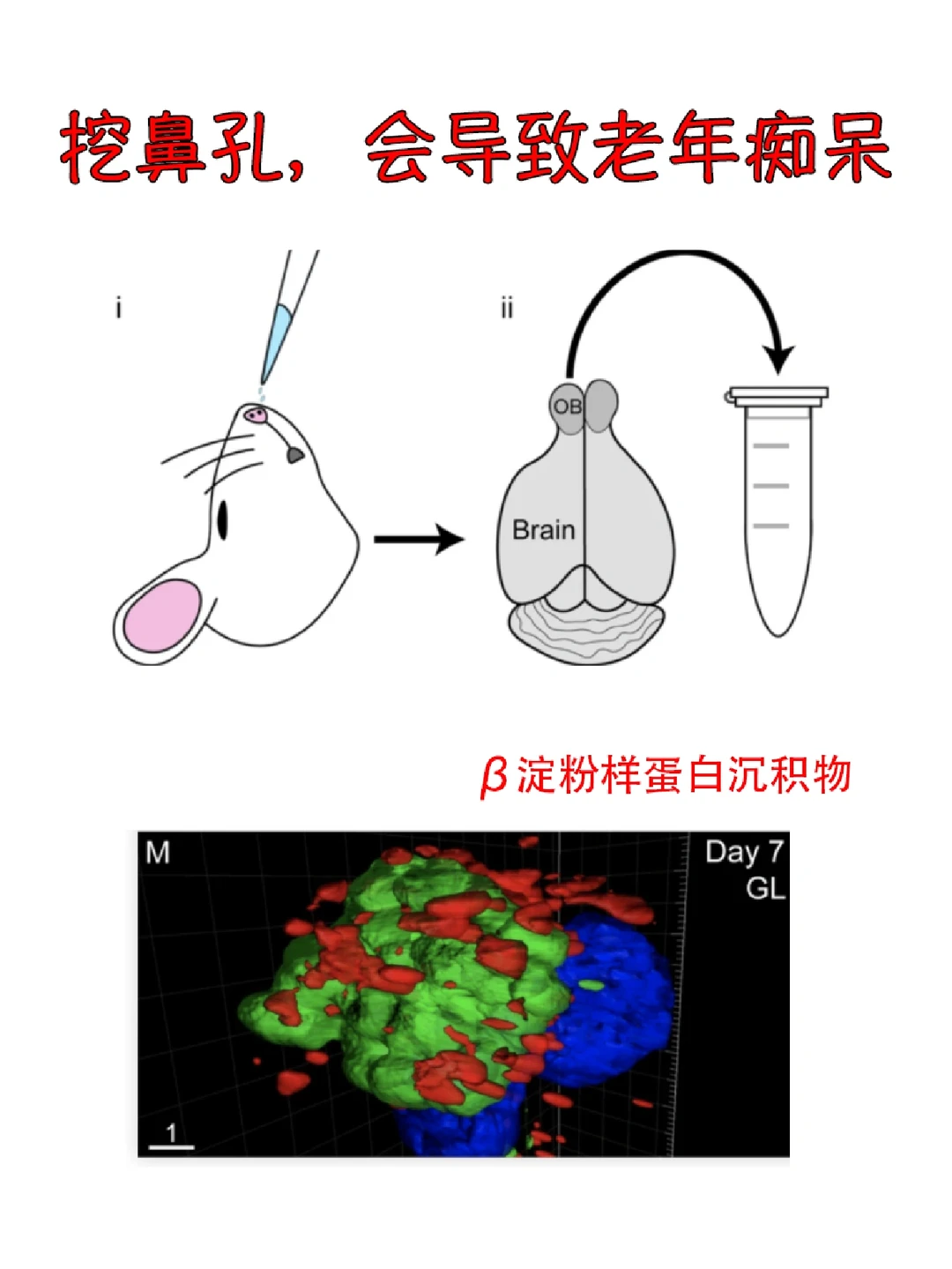 格罗斯曼医学院：挖鼻孔，会变老年痴呆🤯