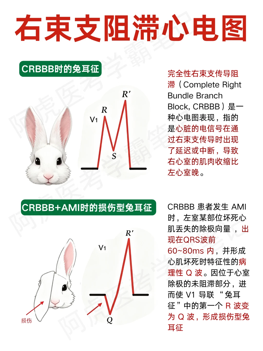 阿虎医考笔记📒右束支阻滞心电图❤️
