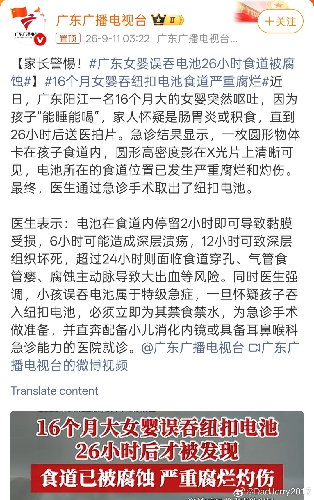 #广东女婴误吞电池26小时食道被腐蚀##16个月女婴吞纽扣电池食道严重腐烂#

除了收纳好高风险物品，比如纽扣电池，针，药物等等，最关键一点是不得让幼儿离开监护人的视线范围（监护人虽然在幼儿旁边，但是长时间看手机，也算是离开视线范围）。

另外，家长认为“积食”，这是基础教育的悲哀。 ​