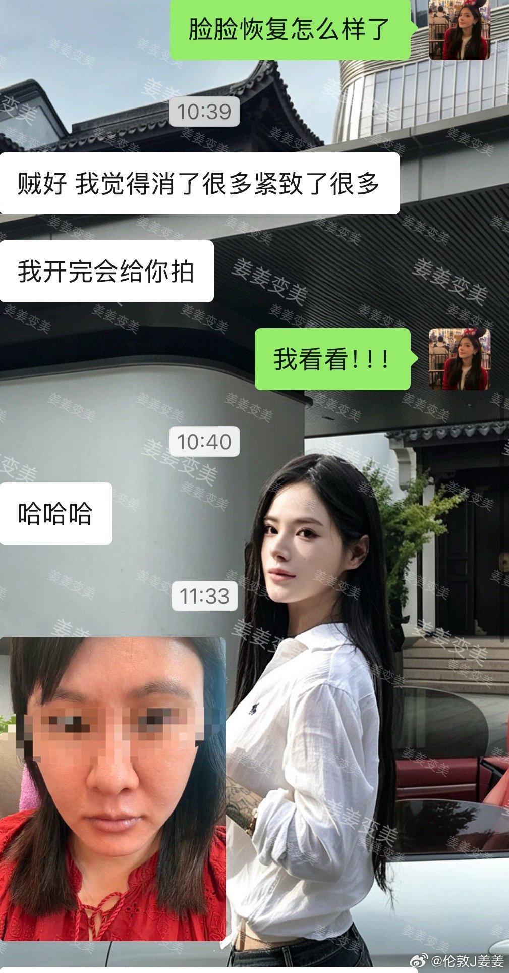 胶原酶对馒化脸和苹果肌肥大的效果实在太好了 闺蜜老医美人，术后13天的效果！而且我们家的打法不那么肿！别家15天还肿得像蜜蜂小狗，我们家13天都已经出惊艳效果了！医美[超话] 2026美力全开  ​​​