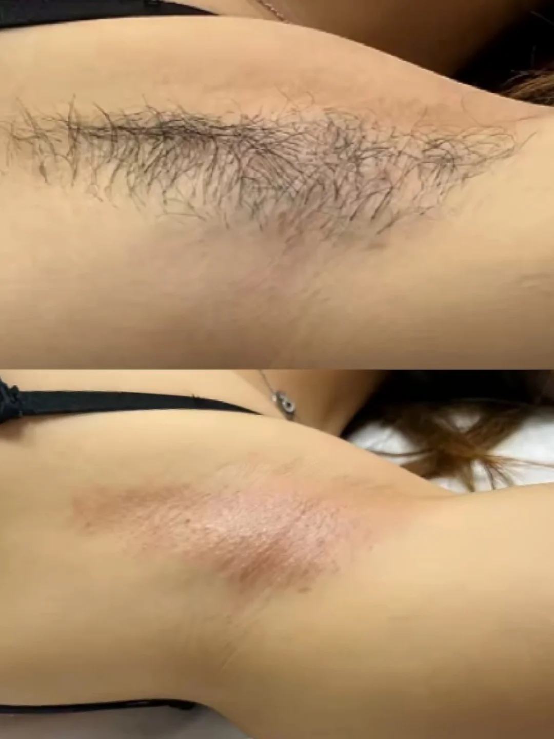 第一次脱腋毛。。奉劝大家别乱脱了！！