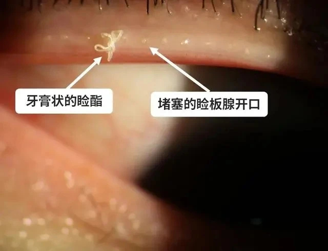 眼睛一会模糊一会清晰