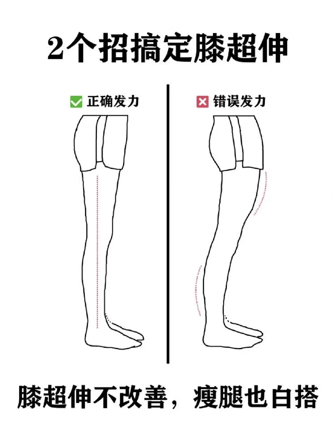 2招矫正膝超伸!直腿必练,逆袭漫画腿