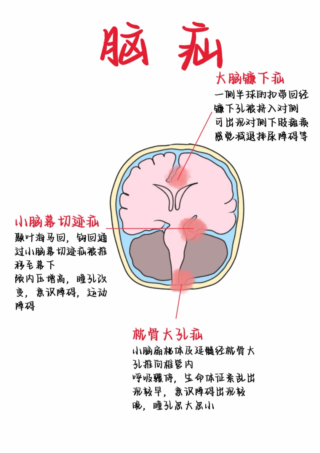 医学生笔记——脑疝