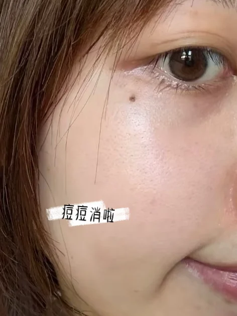 硬痘痘消不掉的都来试试这个