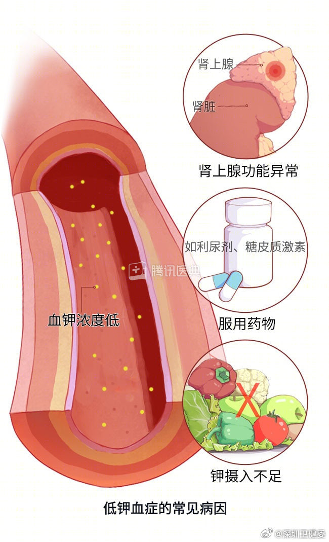 #体重仅70斤吃播女网红或因缺钾猝死# 

钾和钠一样，是体内重要的无机盐，它俩是一对好“搭档”：钾待在细胞里，钠守在细胞外，俩人配合着维持平衡。

心脏跳动、神经-肌肉活动、呼吸等生理功能，都需要正常浓度的钾离子来维持。

夏天由于出汗增多、食欲不佳等原因，身体最容易缺钾。缺了会怎样？看这 ​