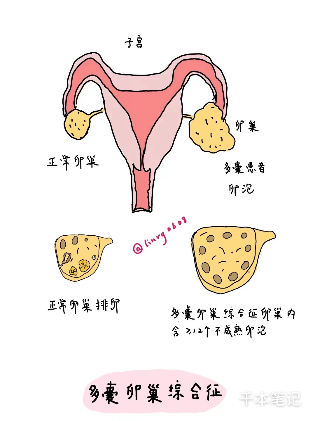 医学生绘本🎨第103弹【多囊卵巢综合征】