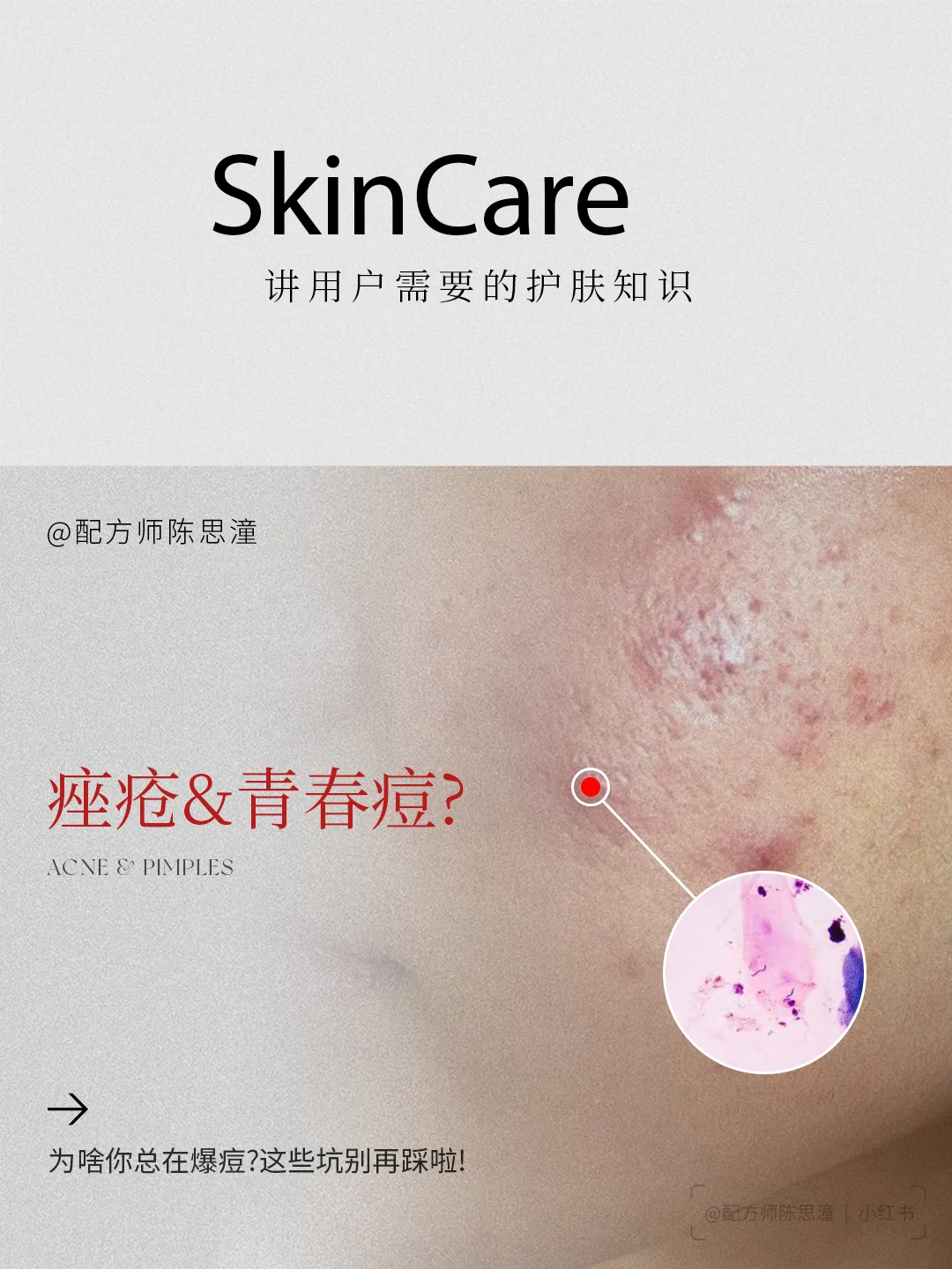 护肤知识｜经常长痘的这篇必看！