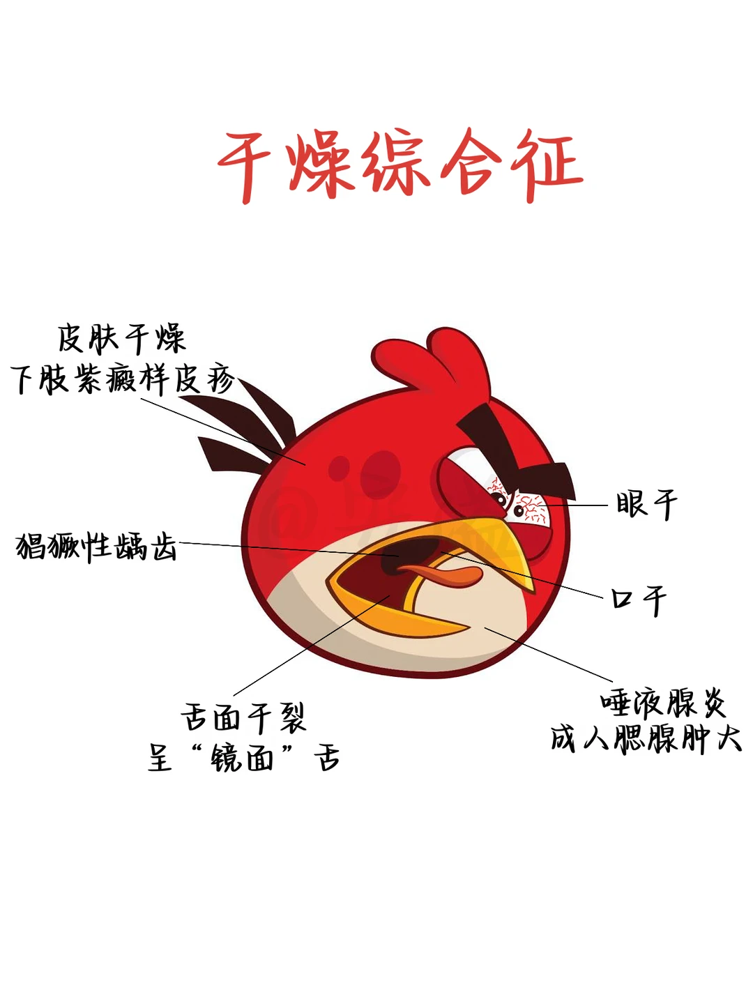 医学生绘本‖干燥综合征