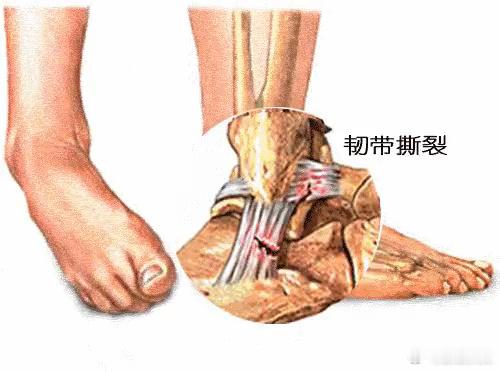 【为什么崴脚扭伤总在踝外侧】姆巴佩在世界杯1/4决赛中脚踝被踢伤后提前...