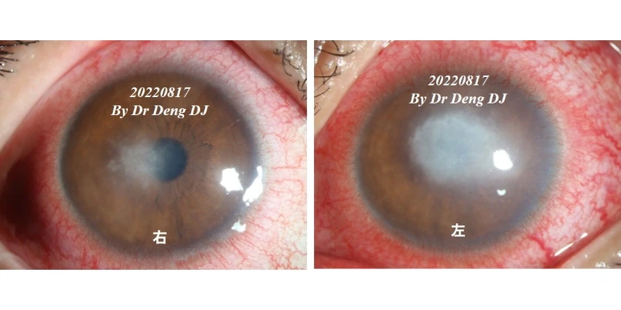 17岁女孩双眼差点失明，戴OK镜要重视护理