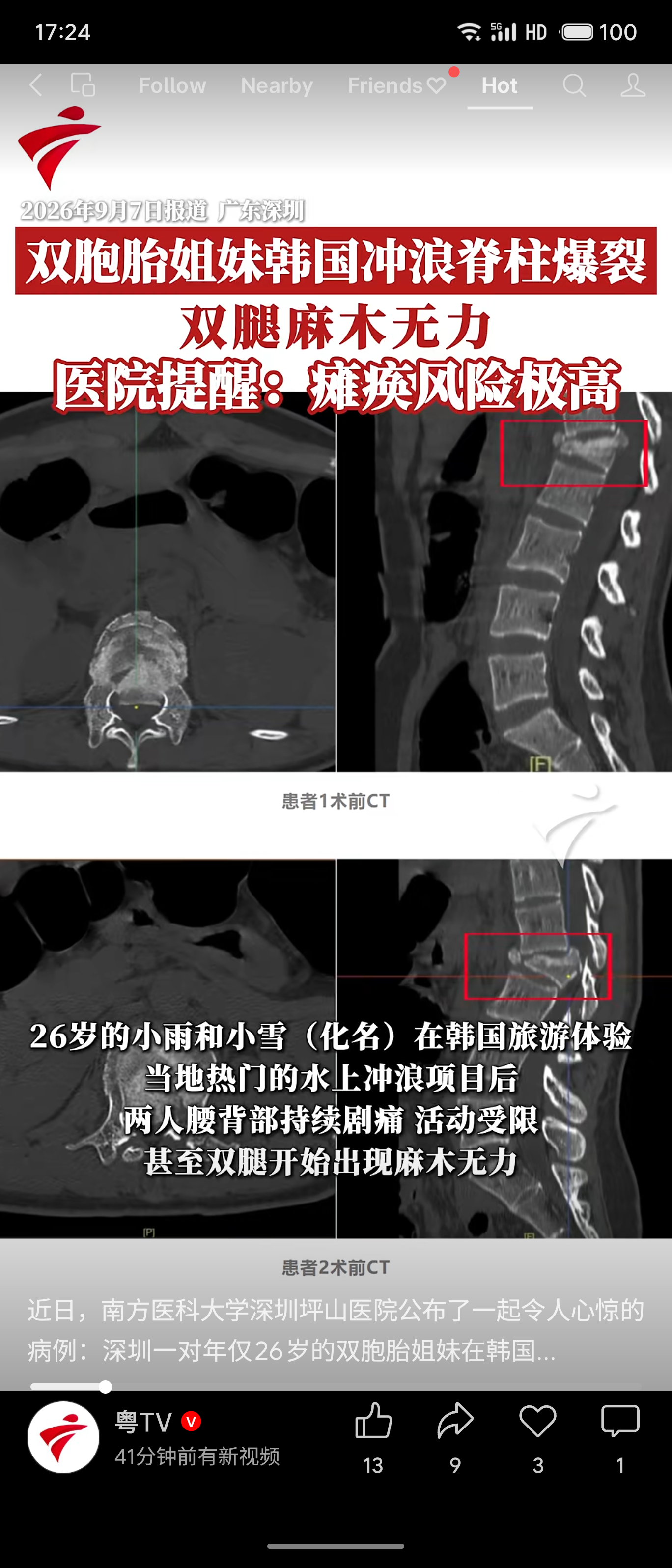 双胞胎姐妹韩国冲浪致脊柱爆裂，险些瘫痪

近日，深圳一对26岁双胞胎姐妹在韩国体验水上冲浪项目时，突感腰部剧震，事后腰背持续疼痛、双腿麻木无力。回国后经南方医科大学深圳坪山医院诊断，两人均为胸腰椎爆裂骨折，骨折块突入椎管压迫脊髓，瘫痪风险极高。所幸及时手术，术后恢复良好。

冲浪本是休闲娱乐，却险些