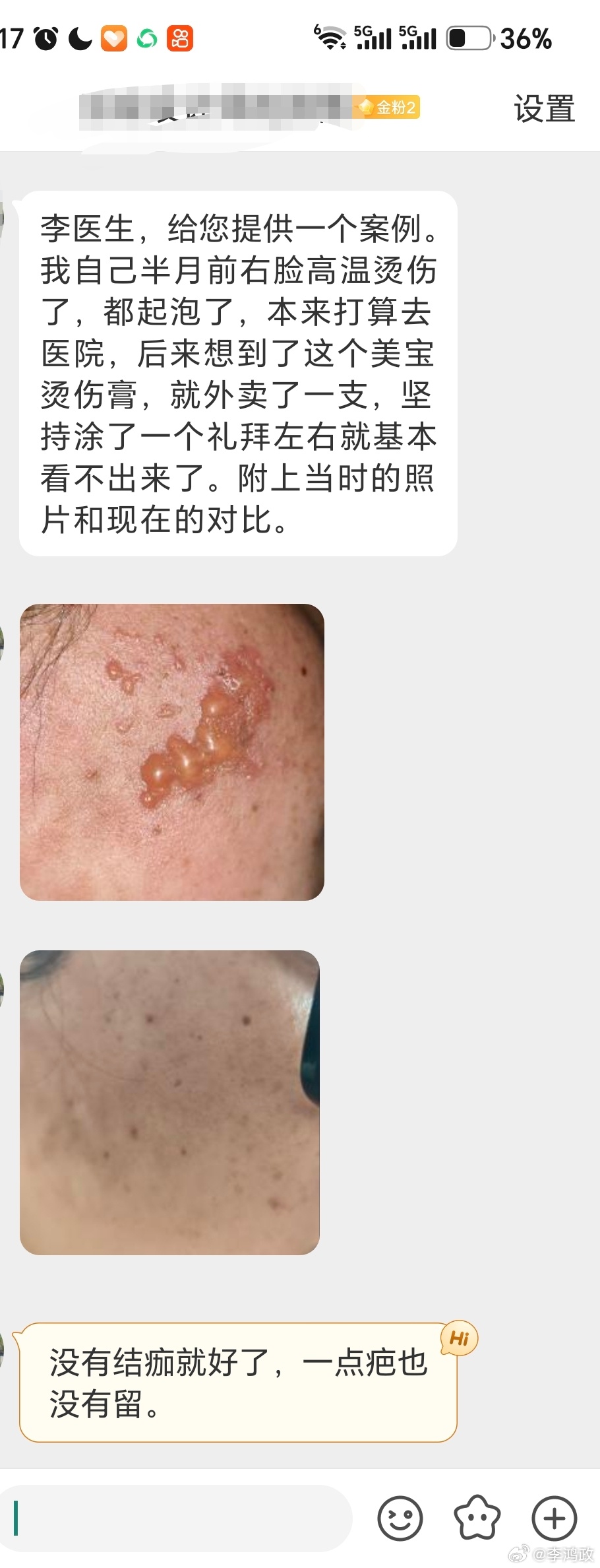湿润烧伤膏，中药烧伤膏，治疗浅二度烫伤是相当容易的，原本浅二度烫伤不会...