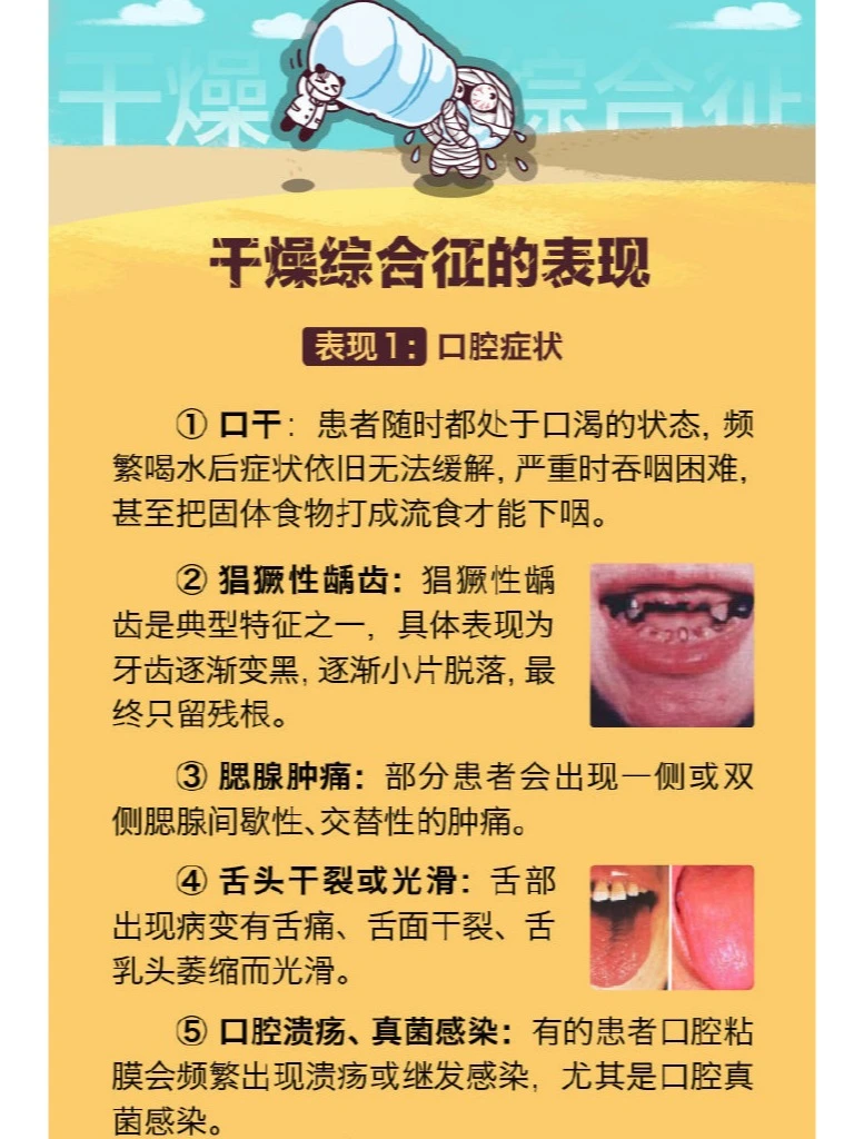 干眼患者，注意排除干燥综合征