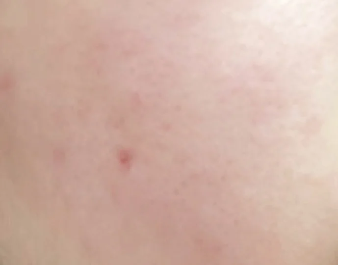 毛孔粗大反复爆痘的都去山姆买这个！！！！！！！！