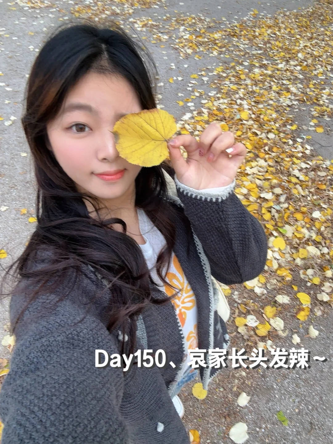 女研究生植发五个月反馈来咯✌🏻