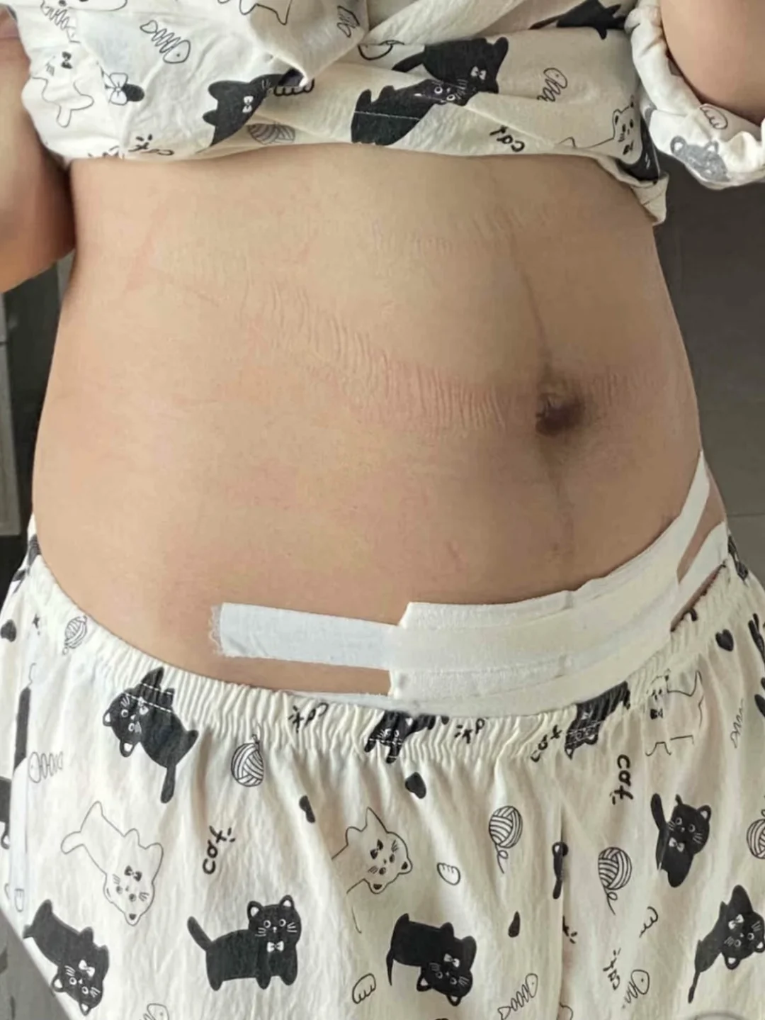 剖腹产后的第十天