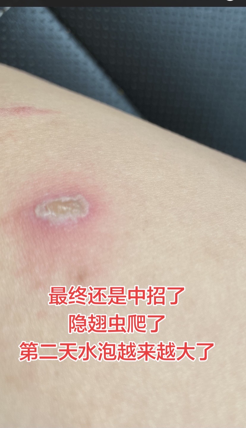 远离隐翅虫
