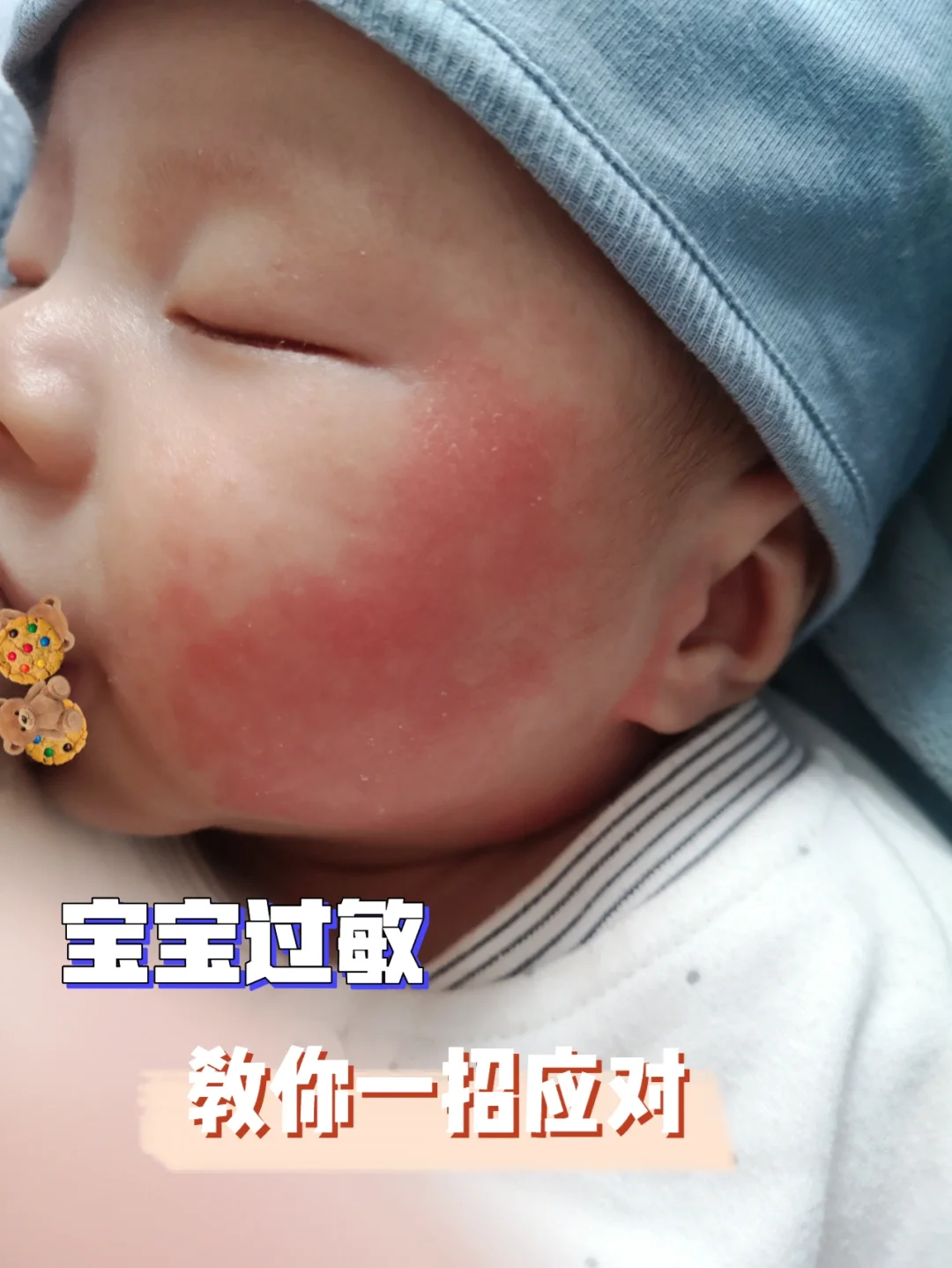 亲身经历教你如何应对宝宝过敏！