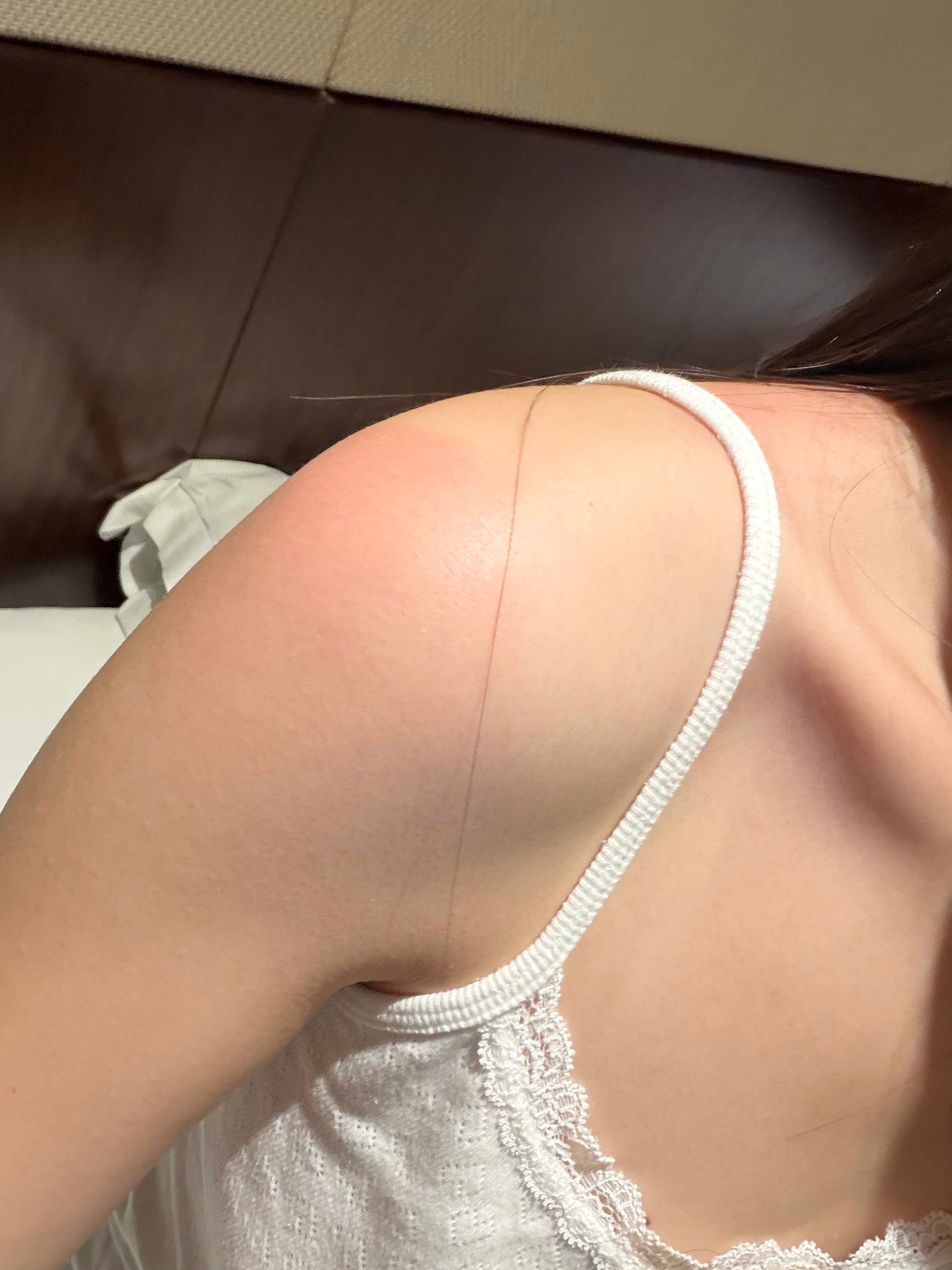 海边的紫外线太强了涂了防晒霜给晒这么红 这个后面会变黑吗 后面要涂什么吗 ​​​