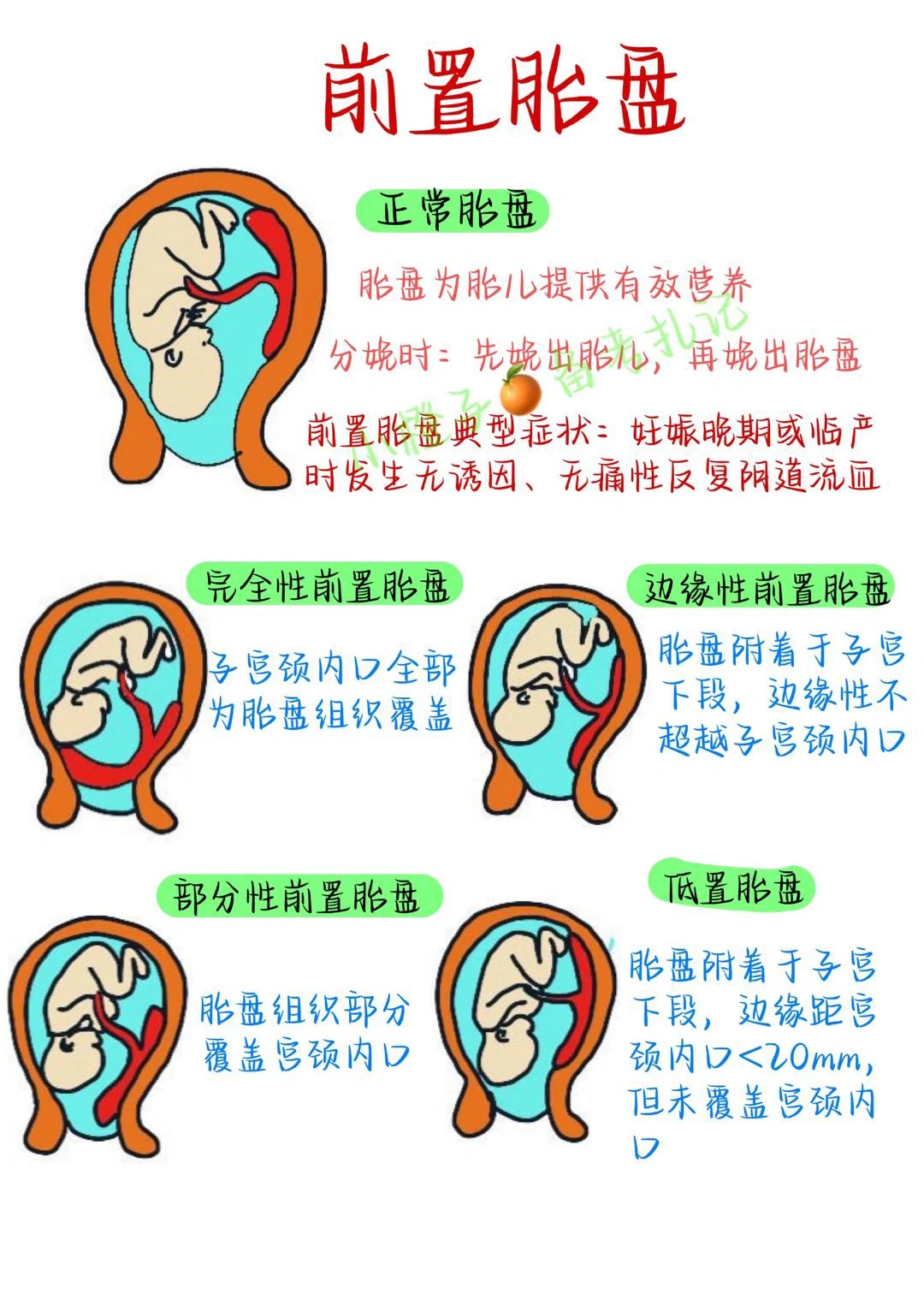 📖护师笔记｜妇产科护理学｜前置胎盘😫