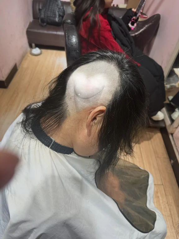 我妈脑袋上的东西五十多年终于取下来了