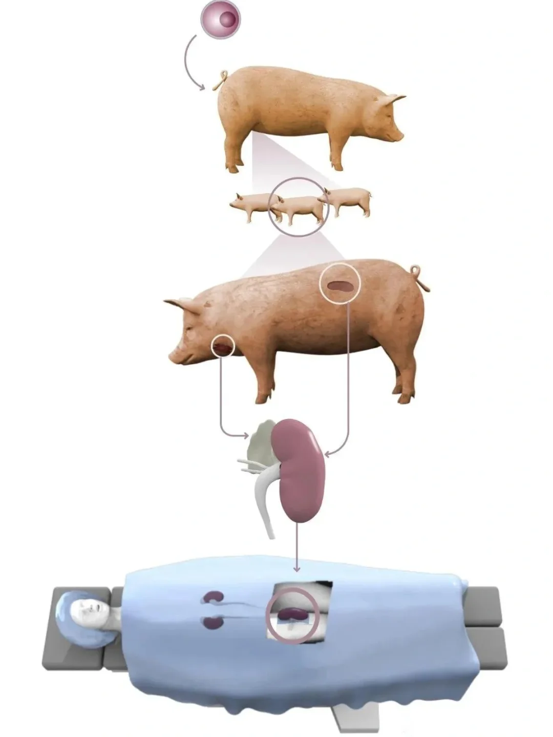 首例猪肾已成功移植人体，暂无排异