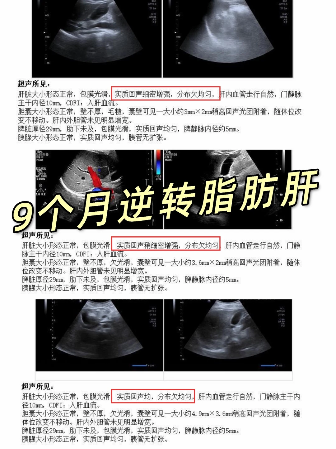 9个月如何只靠饮食逆转脂肪肝❗️