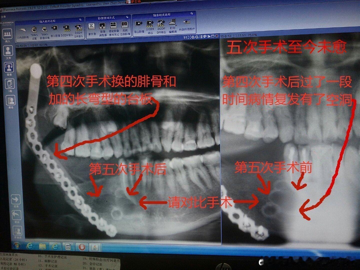 #32岁女子连吃5斤榴莲确诊罕见病#广东省深圳市北京大学深圳医院做的5次手术，第1次至第3次手术做根管治疗和牙下面两个圆空洞位置已经康复没有圆空洞，第4次手术换的腓骨和加的长弯型的台板，过了一段时间第1次至第3次手术位置病情复发有了圆空洞至今未愈，请评论手术和台板固定位置! ​