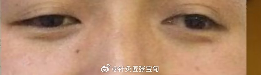 瞟眼。这种两个眼各看各的，属于神官，带有邪气，不是好人，五脏六腑也是混...