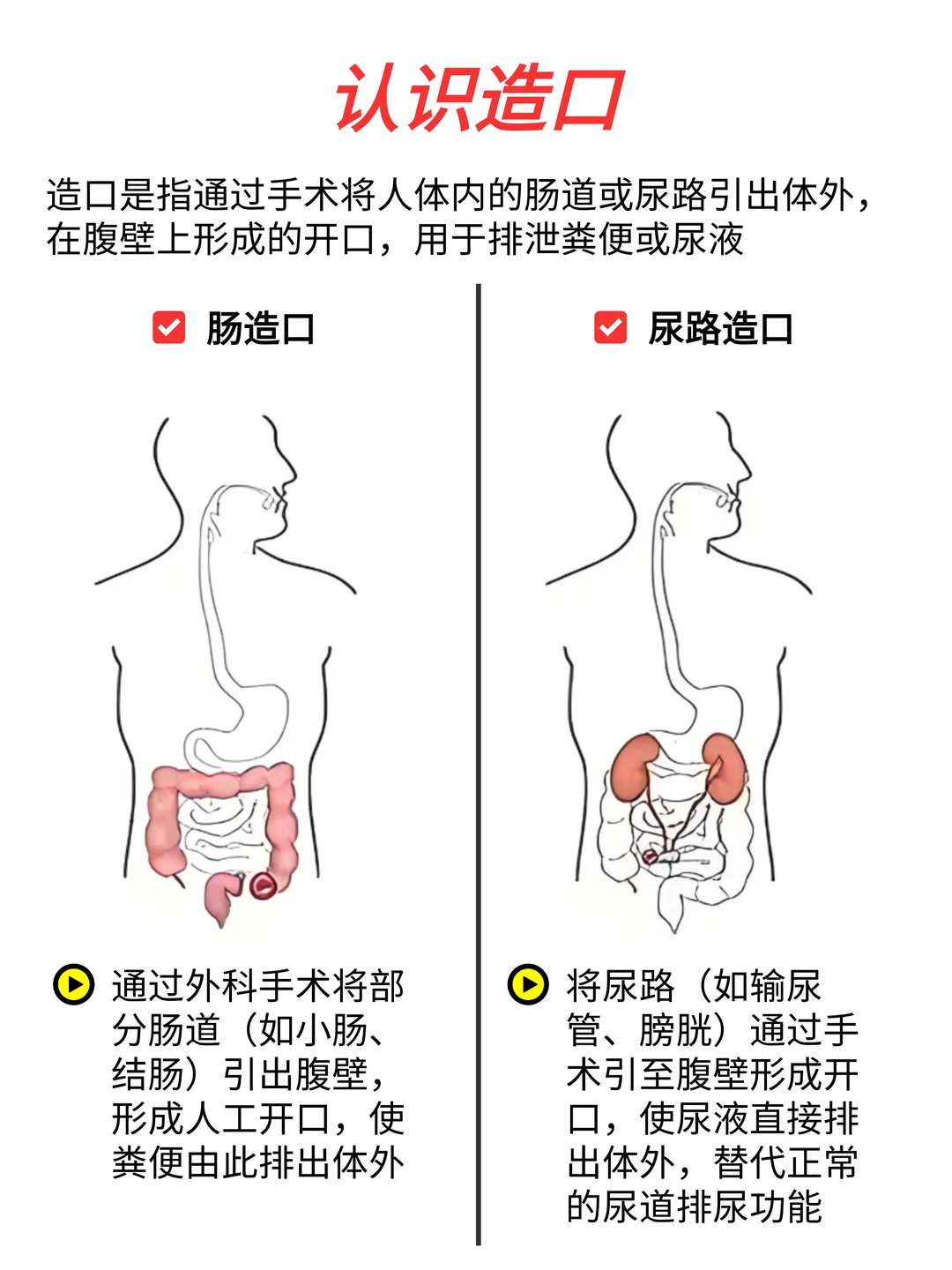 造口不是异类❗❗一篇讲透造口护理全攻略