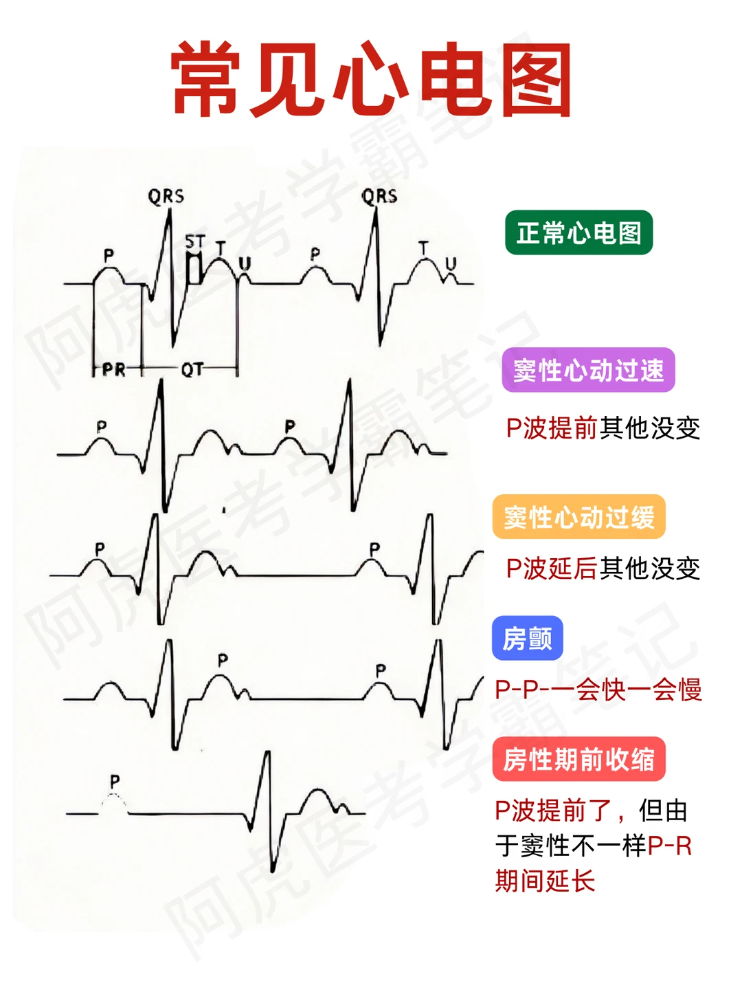阿虎医考笔记📒常见心电图❤️