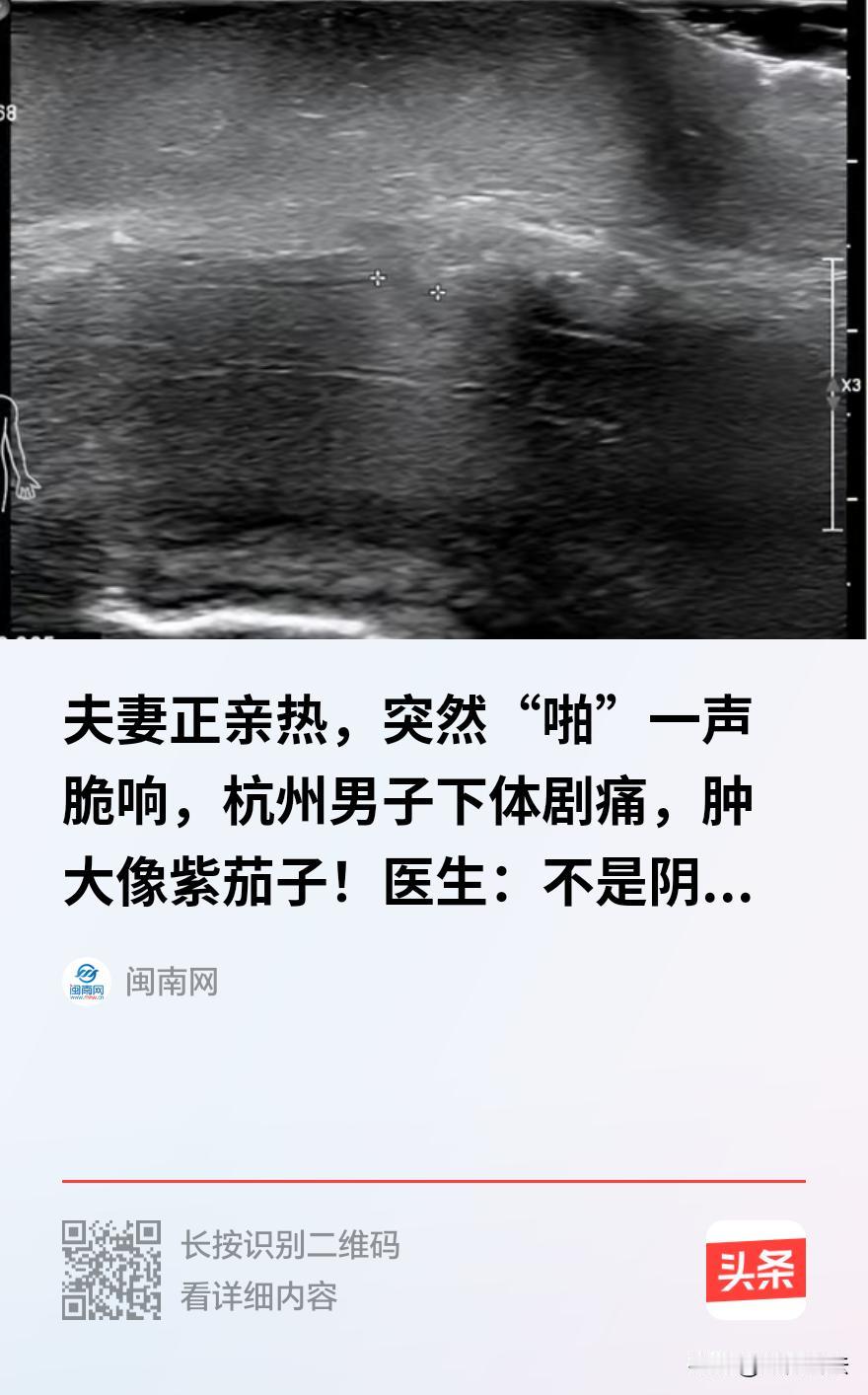一声“啪”响，49岁男子硬扛数小时，差点酿成大祸
半夜的急诊科，一个49岁的男人弓着腰、满头冷汗被妻子搀进来，这画面光是想想就让人捏把汗。他到底怎么了？说出来有点让人脸红——夫妻亲热时用力过猛，下体突然传来一声闷响，疼得他当场蜷成一团。
事情发生在杭州。凌晨时分，家里孩子住校，正是难得清静的时候。季