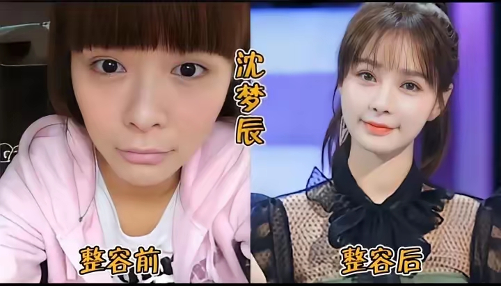 娱乐圈顶级医美成功范本
 说句大实话，沈梦辰的颜值，完全就是顶级医美塑造出来的。 
抛开天生的身高优势，她原生五官其实很普通。我们现在看到的流畅脸型、灵动弯月笑眼、精致的面部线条，全都不是天生，全是后天科技改造的成果。
但必须承认，她是圈内少有的医美天花板级成功案例。
太多人做医美，一味过度填充、盲