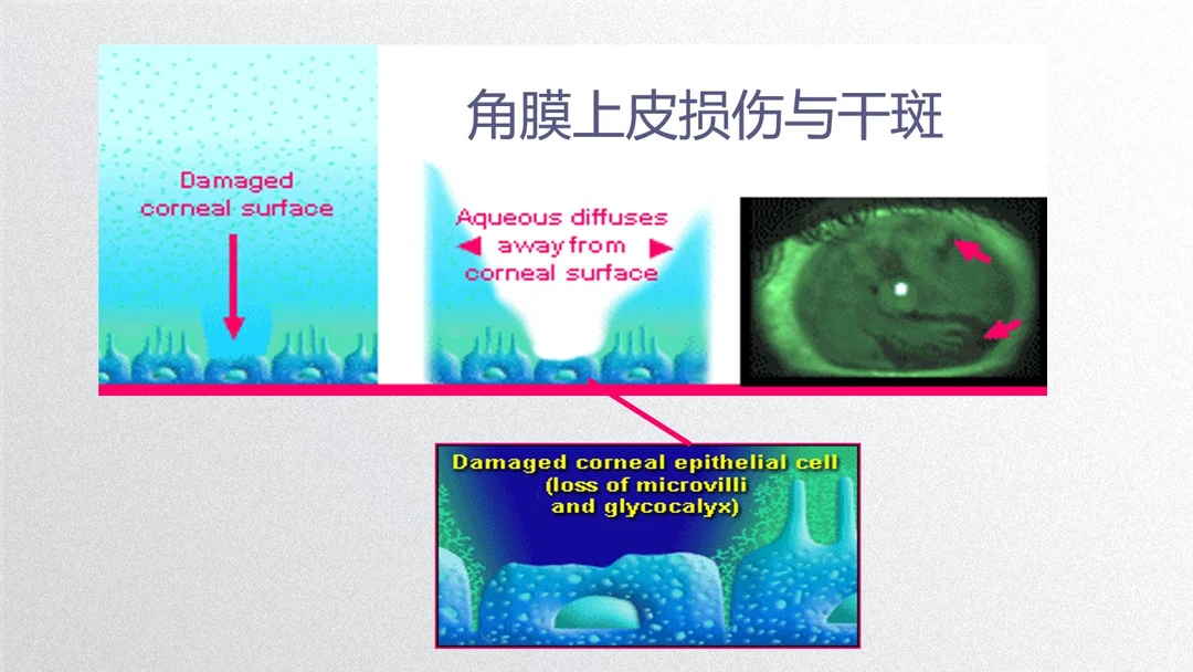 干眼患者角膜上的干斑