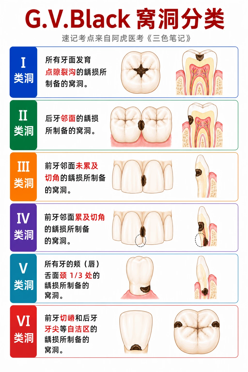 阿虎医考笔记 📒G.V.Black 窝洞分类❤️