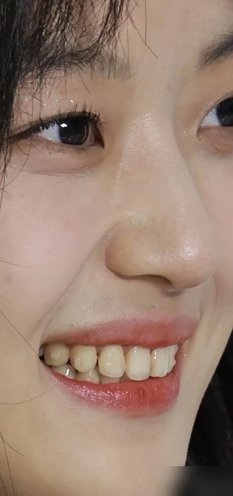 孙千那口牙没动过。
在全内娱恨不得人手一套森白整齐的烤瓷贴面、笑起来像模具压出来的环境里，她留在镜头里的这点不规整，反倒成了稀罕物。
《早春晴朗》热度一路飙到破万，观众盯着尚之桃又哭又笑，大家看重的早不是无可挑剔的皮囊，而是那种没被医美流水线磨平的活泛劲儿。不仅牙没换，就连面对捕风捉影的绯闻，团