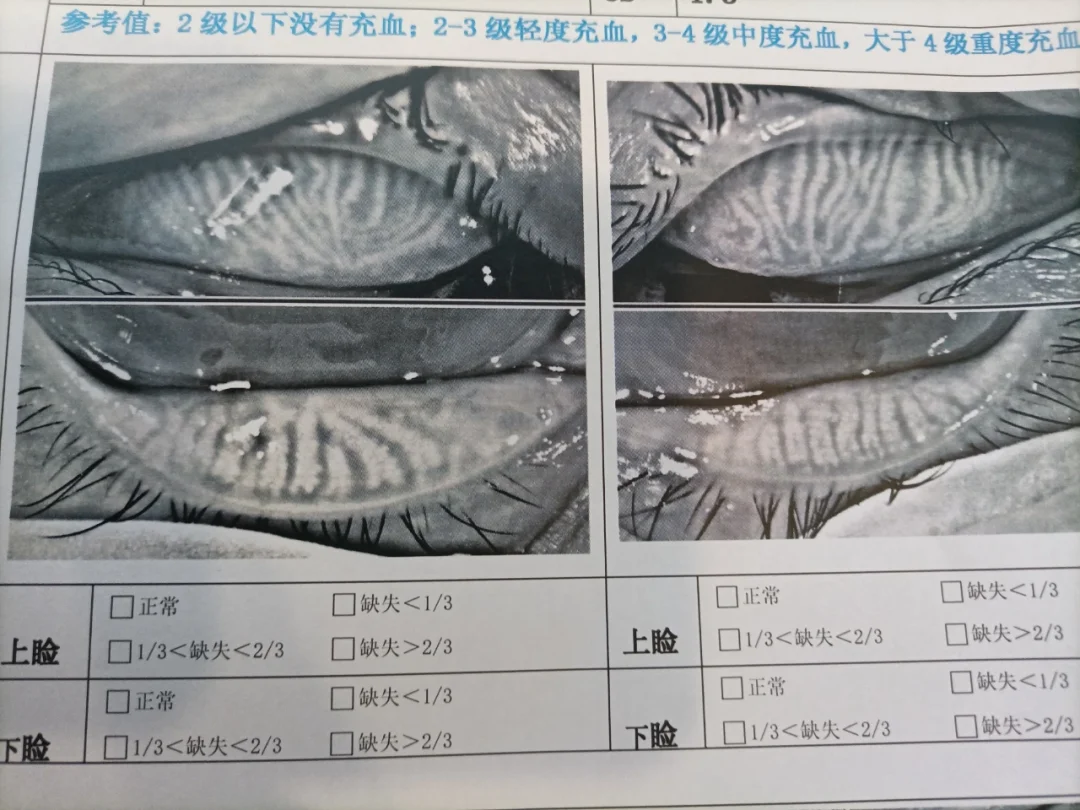 比较健康的睑板腺案例分享