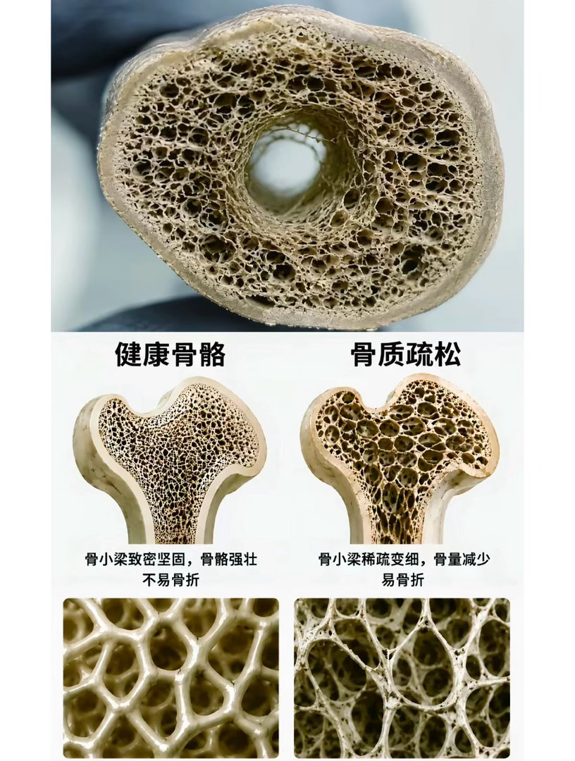 #男子1个拥抱妻子断了5根肋骨#新闻说是体质弱，大错特错，其实就是骨质疏松。

以前我也不理解，为什么有人一摔就骨折，不说那些老人家，突然想起来，我有朋友不也是，才二三十岁，上个健身课都能骨裂，现在懂了，就是骨密度和肌肉的问题，年轻时一定要补，老了再想补就很难了。

关节，骨头都是支撑我 ​