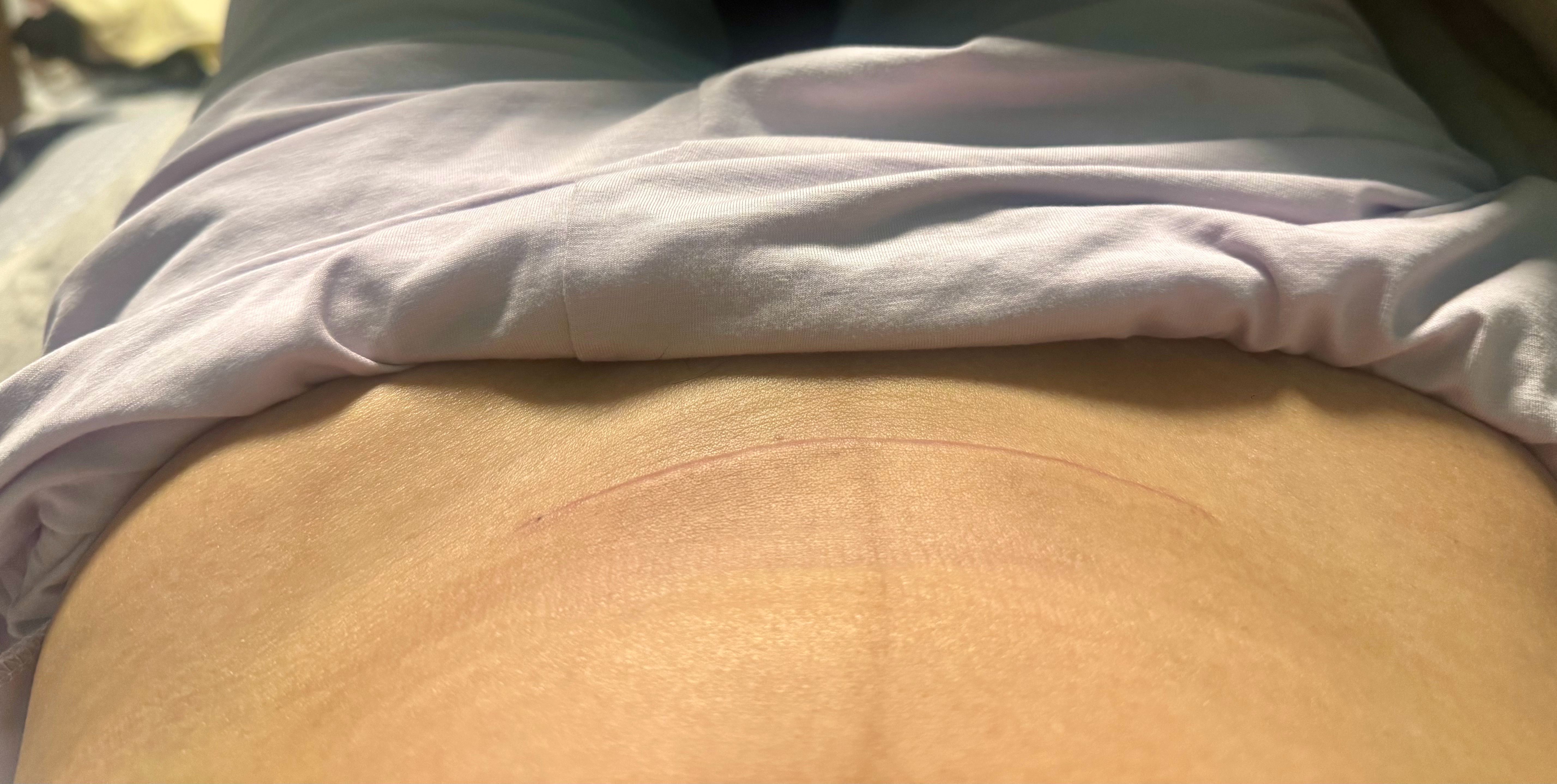 苹果原相机拍的我真是服了就剖腹产那个色素 我之前 天天关注 天天护理 天天在意 结果天天那么黑 弄得我很烦就前几天开始 我累了 也不看 也不管 也不擦任何 随便吧今天一看 它快没了无语 真无语了 大家翻翻前几天照片 那时候还挺黑 就几天没搭理 怎么会如此下贱！ ​​​
