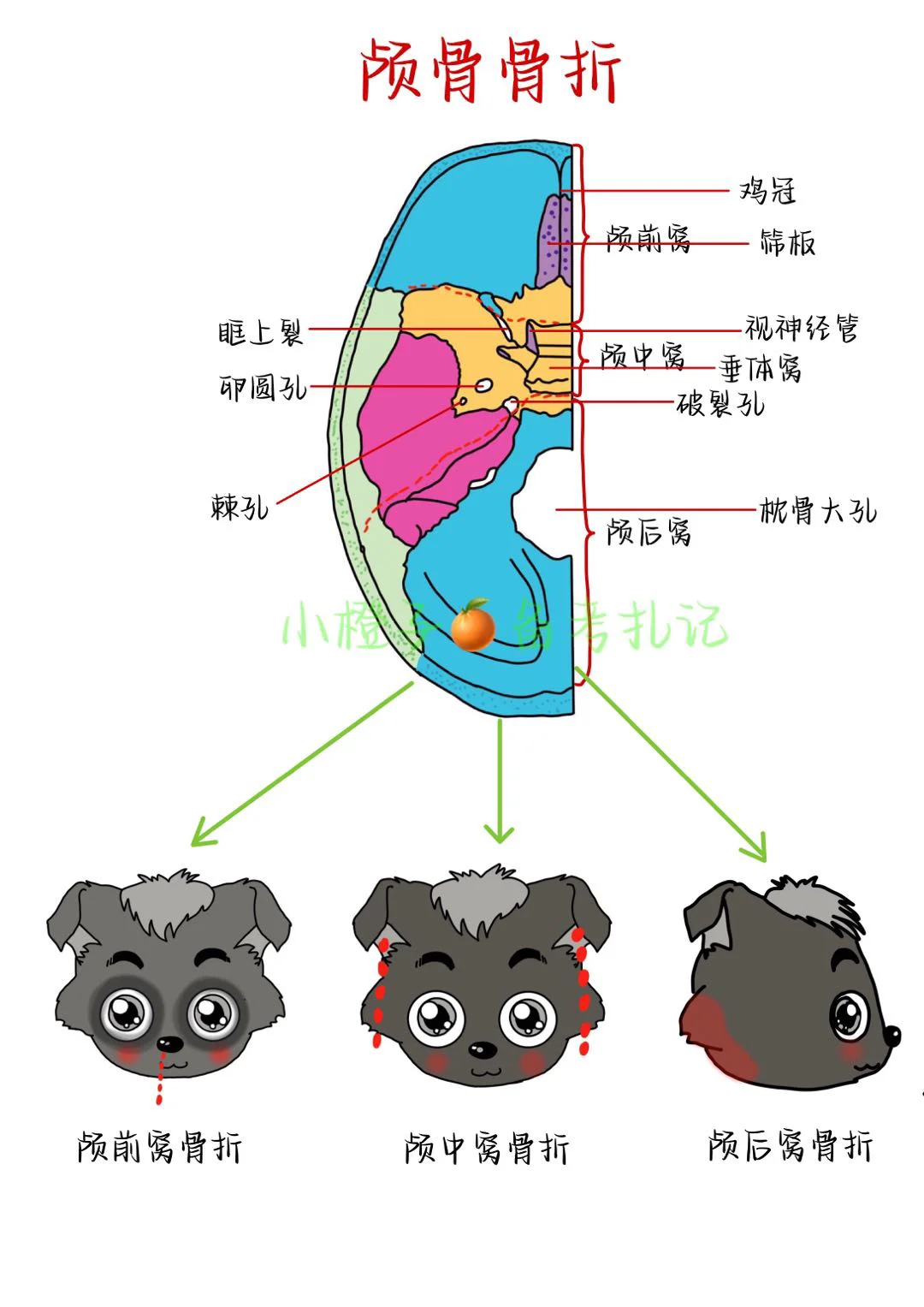📖护师笔记｜外科护理学｜颅骨骨折🦴