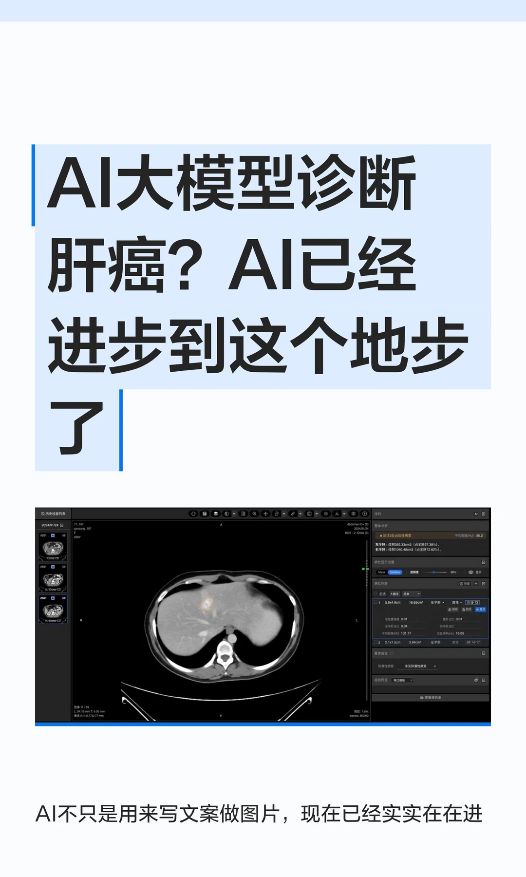 AI大模型诊断肝癌？AI已经进步到这个地步了