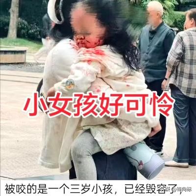 四川眉山一女童被狗咬伤面部，狗主人已被刑拘。我觉得这事儿该严惩，因为有可能毁了女孩的一生。

狗主人刑拘只是第一步，脸部伤对一个孩子来说不只是疼是跟着一辈子的事。大家说得最到位的不是&34;禁狗&34;是&34;管人&34;——牵绳只是最低要求，给狗戴嘴套比牵绳更重要，可99%的养狗人连牵绳都嫌麻烦更别提嘴套。

每次出事