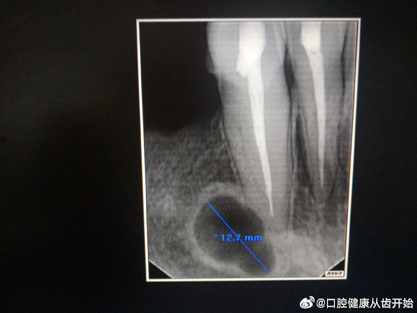 #24岁医学女博士不认识手术器械#广东省深圳市北京大学深圳医院做的5次手术，第1次至第3次手术做根管治疗和牙下面两个圆空洞位置已经康复没有圆空洞，第4次手术换的腓骨和加的长弯型的台板，过了一段时间第1次至第3次手术位置病情复发有了圆空洞至今未愈，请评论手术和台板固定位置! ​