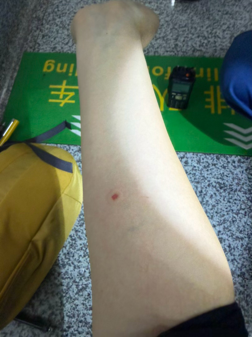 高高兴兴去徒步，好不容易走完17公里，返程的时候，有只马蜂扒在书包侧兜的登山杖上一路带到了地铁上，毫无疑问，被狠狠地蛰了一口，剧痛，巨痛，无敌爆痛，去最近的社区医院没医生上班，又改去其他医院的路上狂风暴雨，幸好当时在车里，伞也没带，衣服也不防水，幸好cc带了垃圾袋，还能给被蛰的胳膊挡 ​
