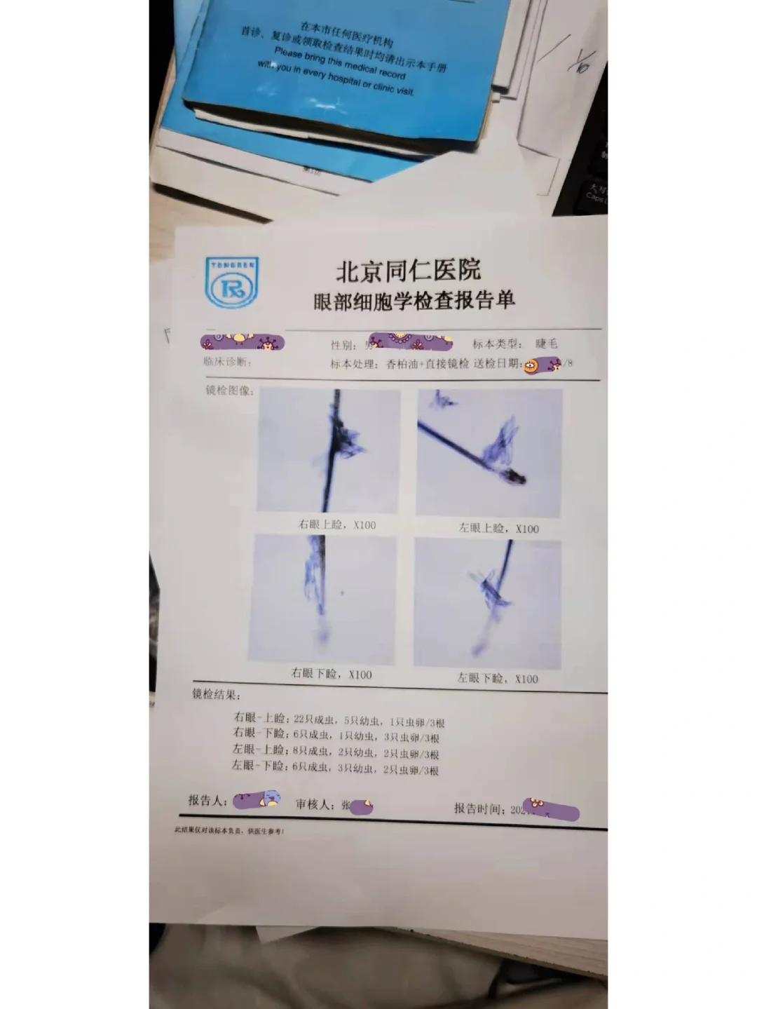 睫毛根部的螨虫，有没有头皮发麻