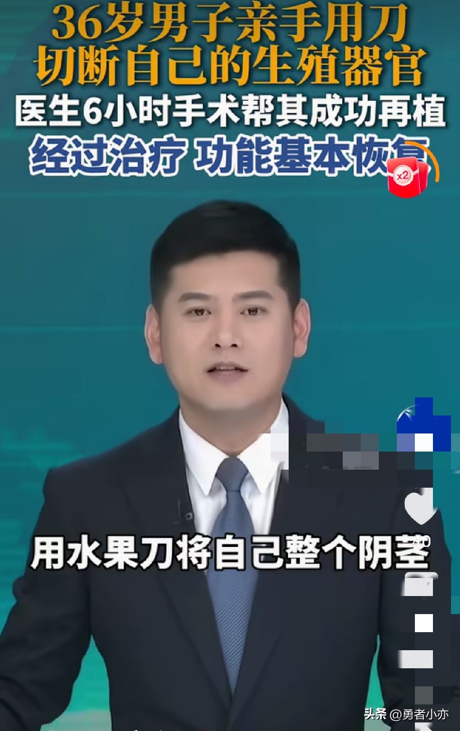 是个狠人！男子拿水果刀从根部切断了自己的生殖器官，医生耗时6个小时为其成功再植，功能基本恢复。

湖南郴州，一名男子被家属紧急送医，医生检查后发现他的整个阴茎完全断离，情况十分凶险，必须马上开展手术。

器官断离后的缺血耐受有极为严苛的“黄金窗口”，医生在显微镜下耗时六个多小时完成精细吻合，顺利完成