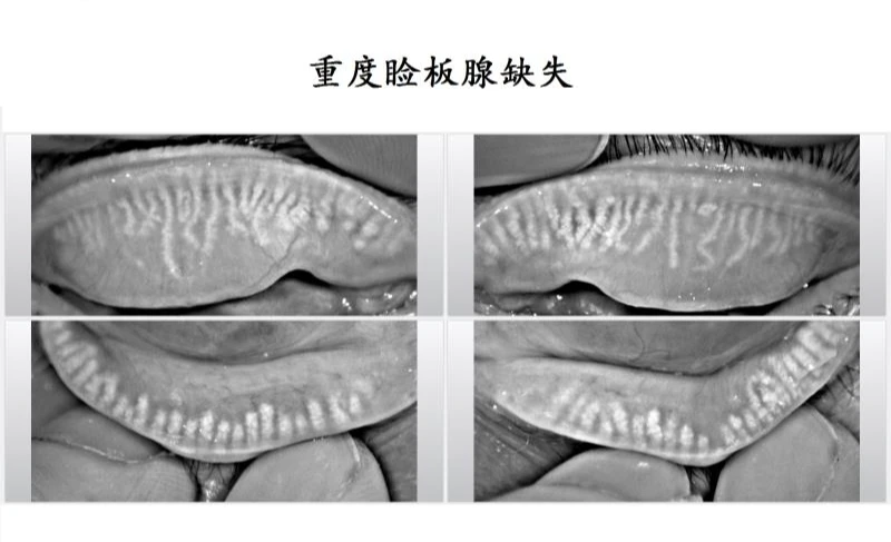 门诊一位睑板腺萎缩缺失特别严重的患者，接近下图。她说之前做了近视手术，术后感觉眼