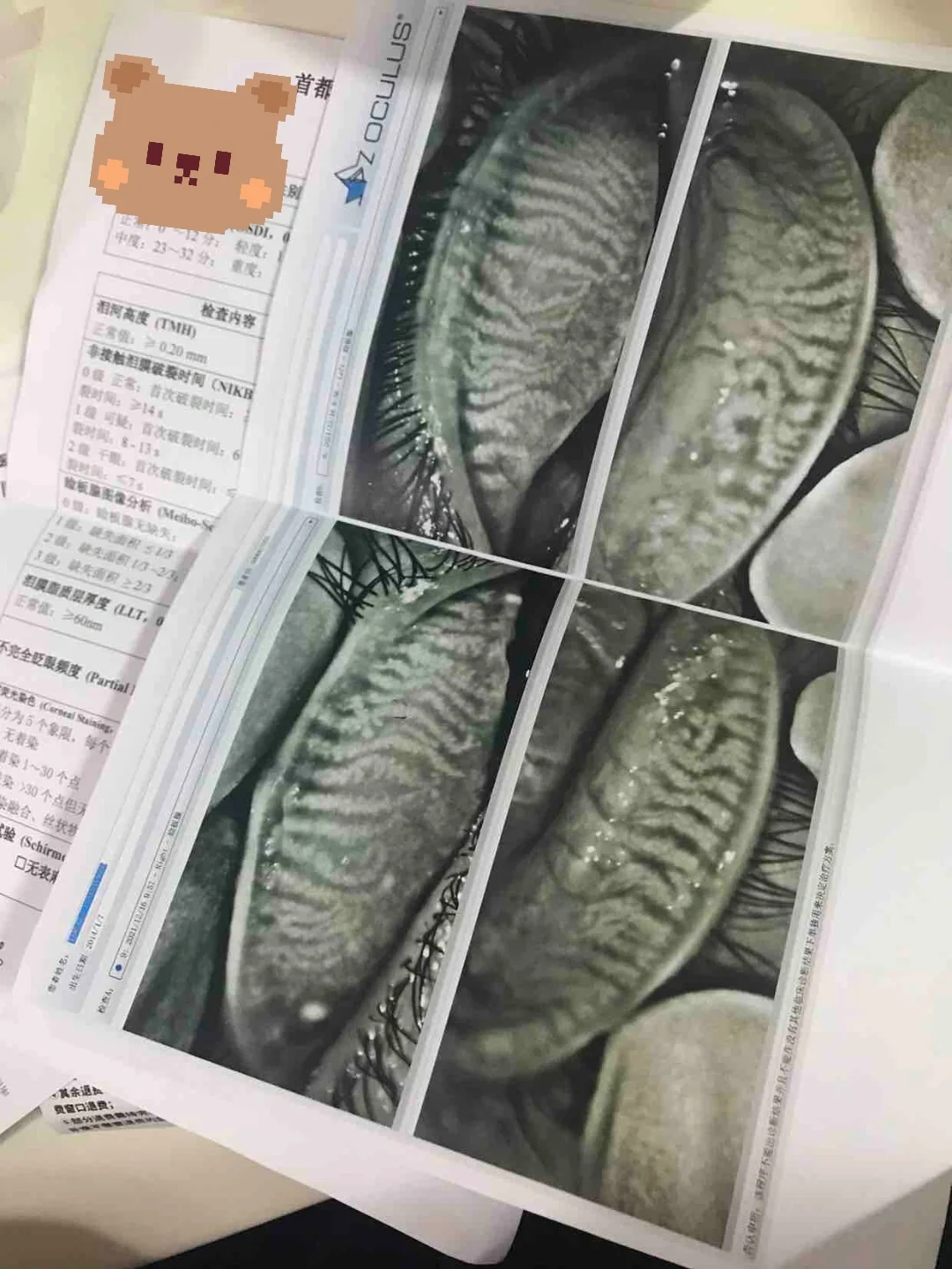 做近视手术除了年龄度数，还要注意这个