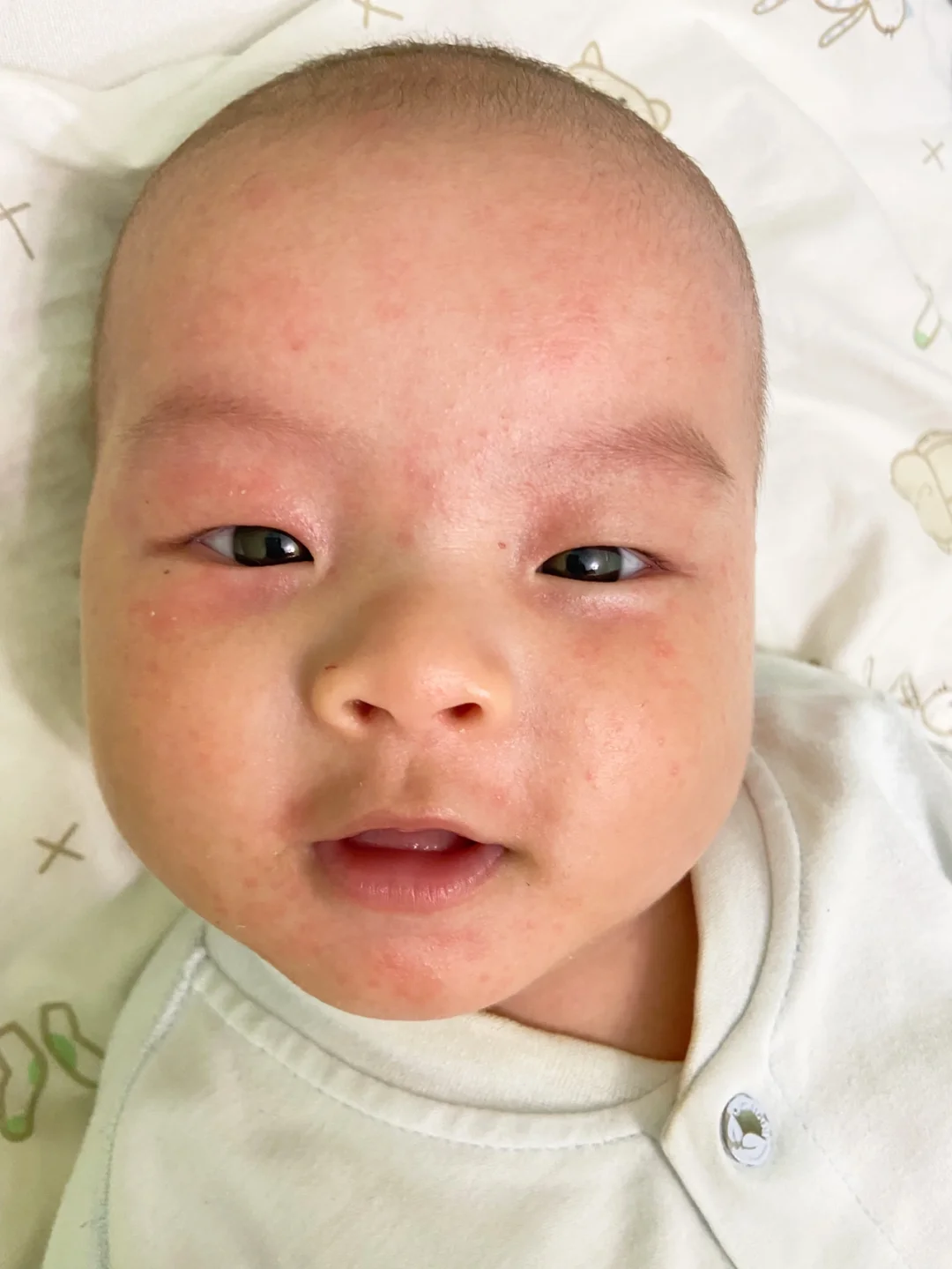 湿疹爆发的第4天，还是没忍住去了医院🏥……